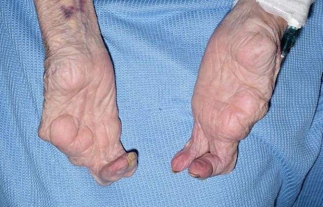 94-летняя бабушка-лобстер наповал сразила врачей 