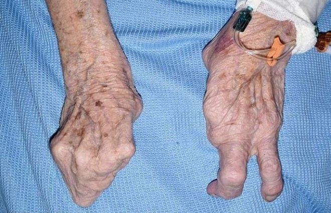 94-летняя бабушка-лобстер наповал сразила врачей 