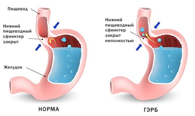Гастроэзофагеальный рефлюкс