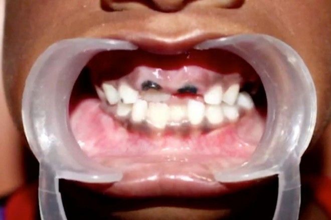 Врачи удалили 526 зубов у семилетнего мальчика из Индии